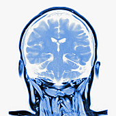 Multiple sclerosis, brain MRI sequence