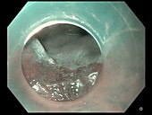 Barrett's oesophagus, endoscope view