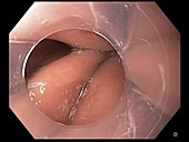 Barrett's oesophagus, endoscope view