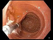 Gastritis, endoscope view