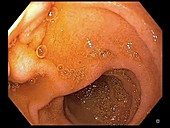 Duodenum in Barrett's oesophagus