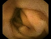 Small intestine, pill camera footage