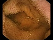 Small intestine, pill camera footage