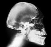 Microcephaly,X-ray