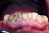 Dental caries and plaque