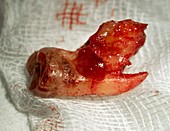 Extracted wisdom tooth