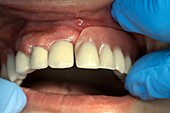 Dental bridge and denture