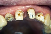 Teeth prepared for dental crowns