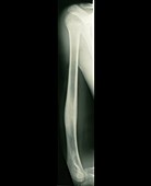 X-ray of osteoid osteoma in humerus bone of arm