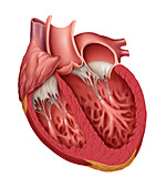 Enlarged Left Ventricle