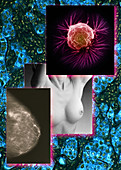 Breast Cancer Montage