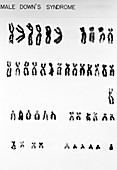 Down's Syndrome karyotype