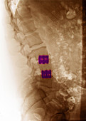 Spinal Fusion