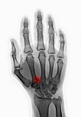 'Fractured Hand,X-Ray'