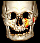 'Facial Fractures,CT Scan'