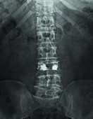 X-Ray of Kyphoplasty