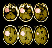 Brain Tumor