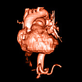 3D CTA of Heart