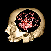3D Image of Skull and Brain AVM