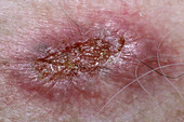 Ulcerated basal cell carcinoma