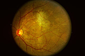 Eye Tumor