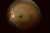 Retinal Coloboma
