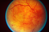 Retinal Papilledema