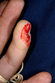 Partial Amputation of the Fingertip