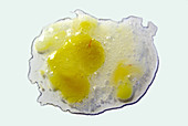 Yellow Sputum