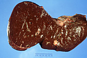 Congested Liver