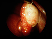 Sclerocystic Ovary