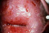 Herpes of the Cervix