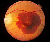 Retinal Hemorrhage (2 of 3)