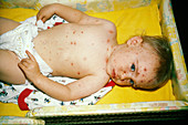 Baby with Chickenpox