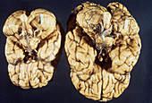 Microcephalic & Normal Brain