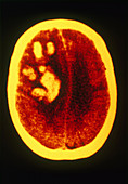 'Brain Hemorrhage,CT Scan'