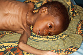 African child dying of AIDS