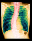 X-Ray of COPD and Scoliosis
