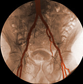 Angiogram of Iliac Arteries