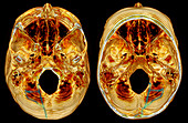 3D CT Reconstruction of Skull Fracture
