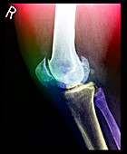 Bone Spurs in Knee
