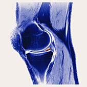 'Meniscal Tear in Knee,MRI'