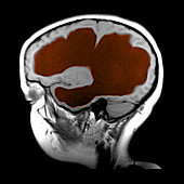 Hydrocephalus of Lateral Ventricle