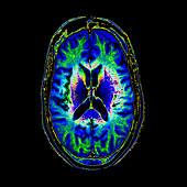 Normal MRI of Brain