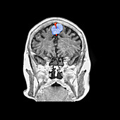 Color Enhanced MRI of Falx Meningioma