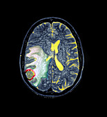 MRI of Metastatic Brain Lesion