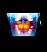 Odontoid X-Ray