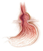 Gastroesophageal Reflux and Hiatal Hernia