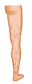 Varicose Veins