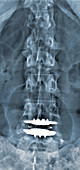 'Lumbar Vertebrae Arthroplasty,X-Ray'